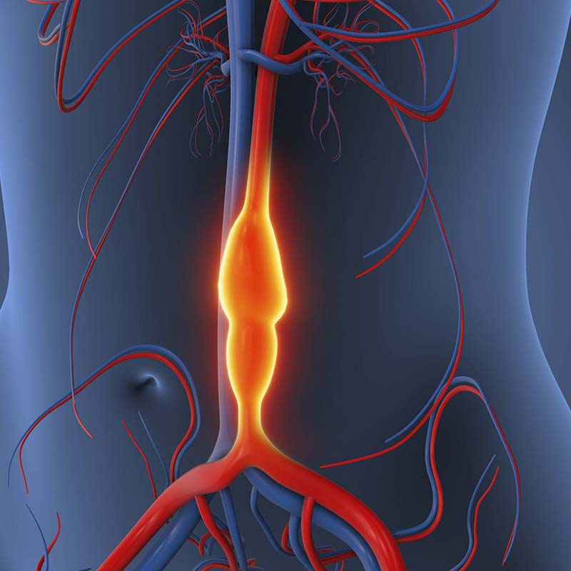 Abdominal Aortic Aneurysm causing vessel enlargement 3d illustration