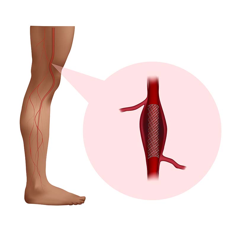 Popliteal aneurysm stenting. Before and after surgery. Medical anatomy illustration.