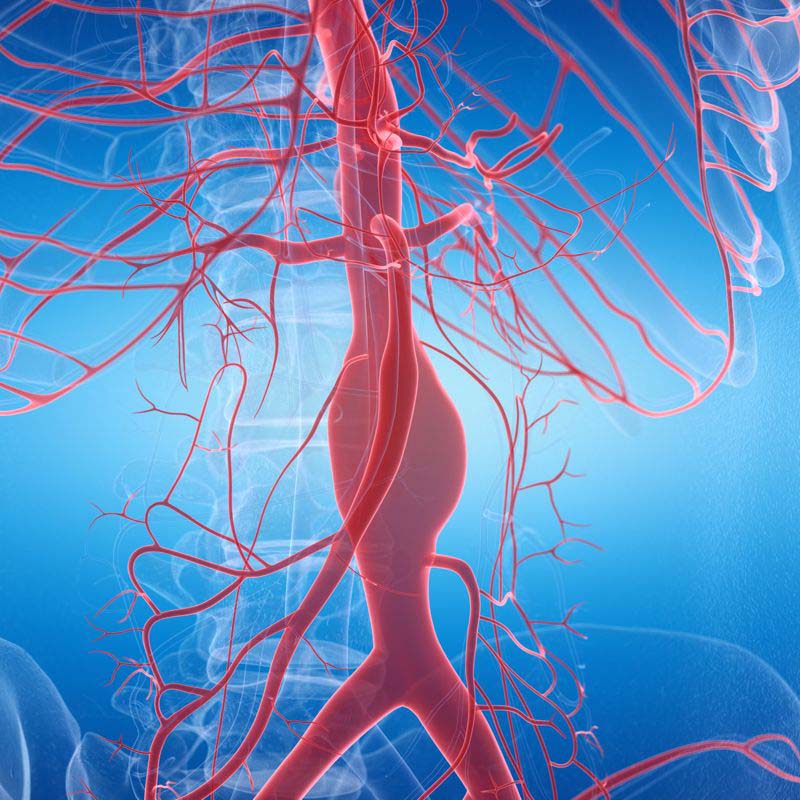 Aneurisma da aorta tóraco-abdominal t01