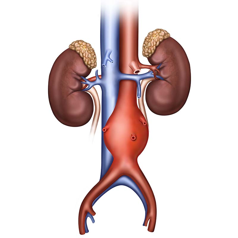 Illustration of kidney area with a fusiform abdominal aortic aneurysm.