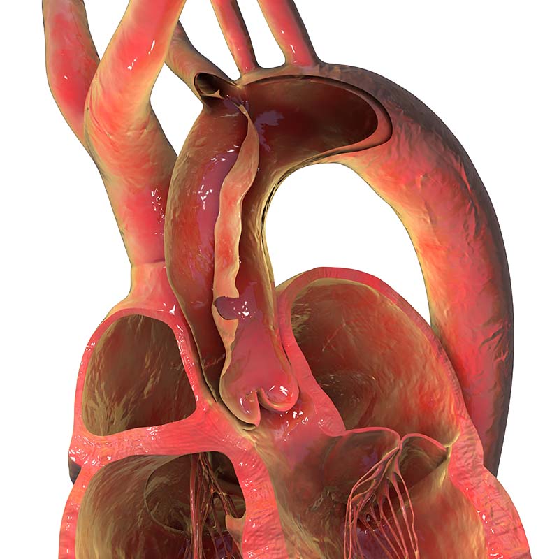Ascending aortic dissection, 3D illustration. Shows intimal tear and formation of false lumen in the ascending aorta, a life-threatening cardiovascular emergency.