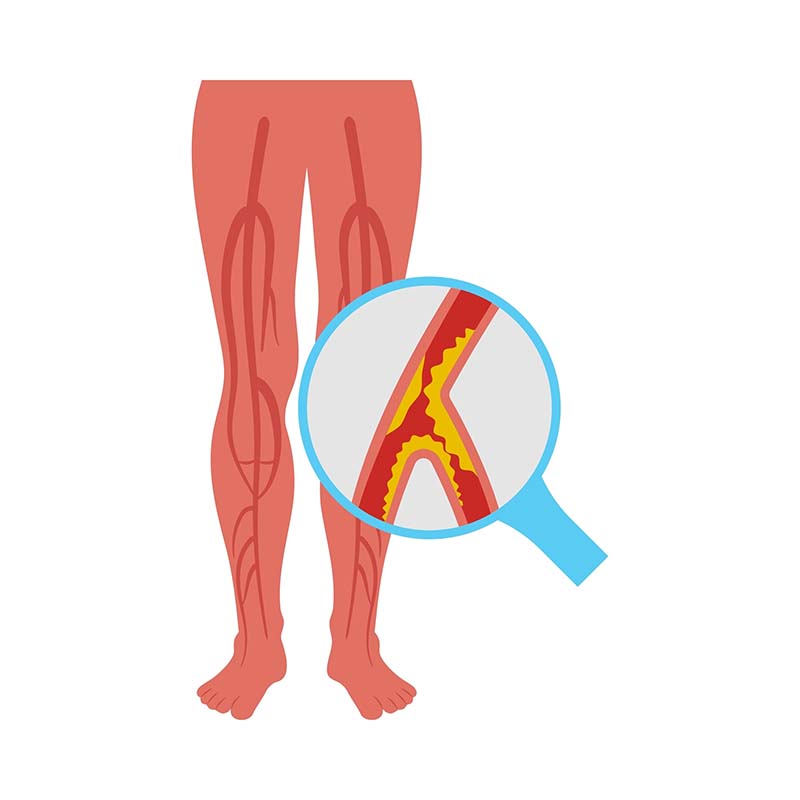 Peripheral Artery Disease, Cardiovascular Disease Illustration Icon