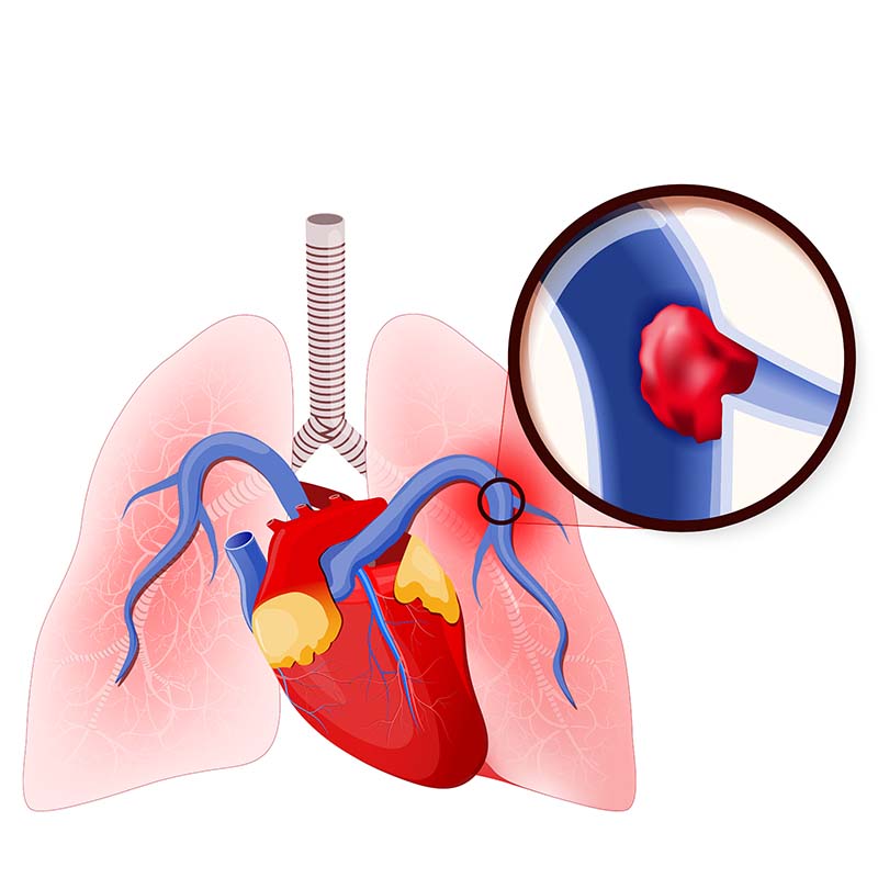 Pulmonary embolism. Blockage of the main artery of the lung or one of its branches by a blood clot. Human lungs and heart. blood clot in the vein (close- up)